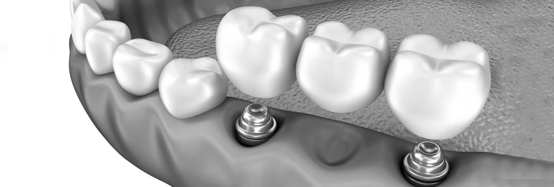 Dental bridge supported by implants - Signature Smiles Dental