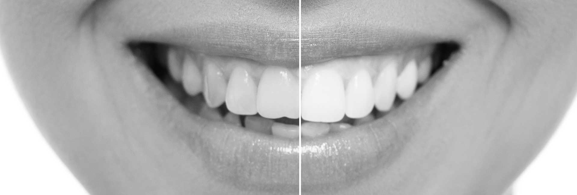 Female Teeth Between Before And After Dental