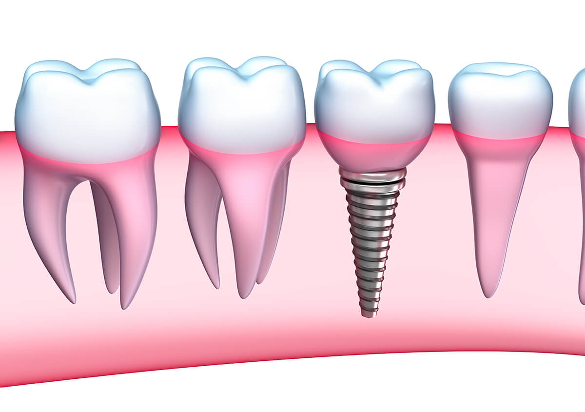 Teeth Implants Dentist in Riverside CA Area