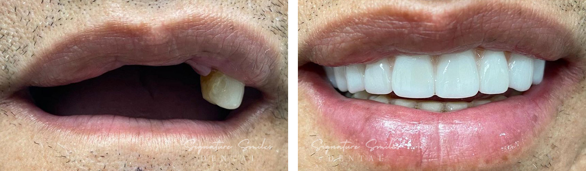 Implants before and after images Signature Smiles Dental 001