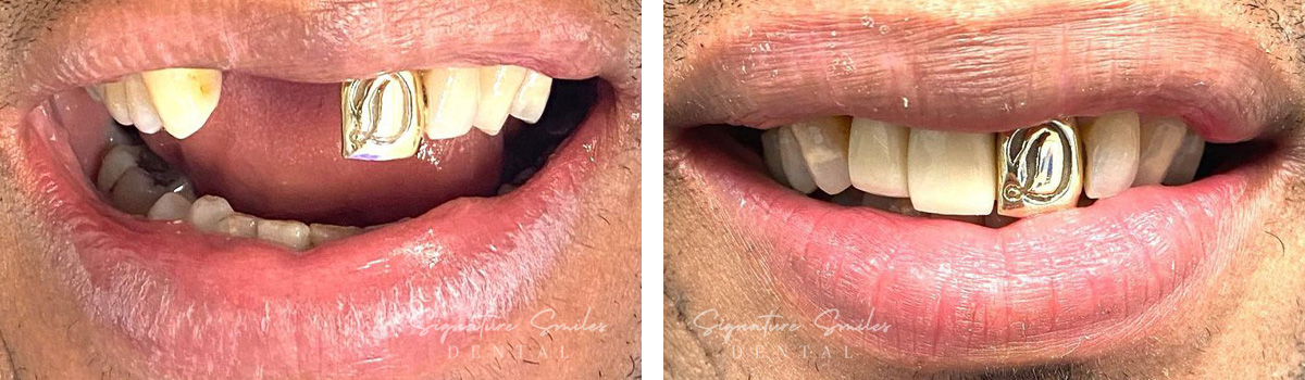 Implants before and after images Signature Smiles Dental 002