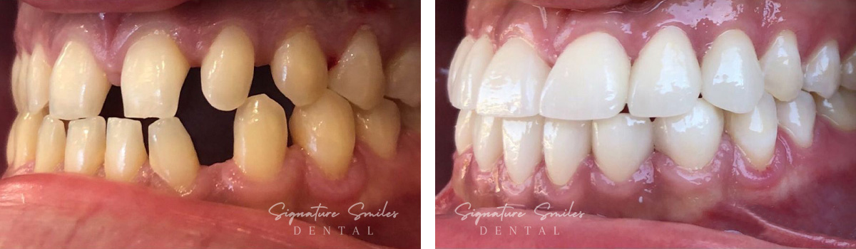 Porcelain Veneers before and after images Signature Smiles Dental 001
