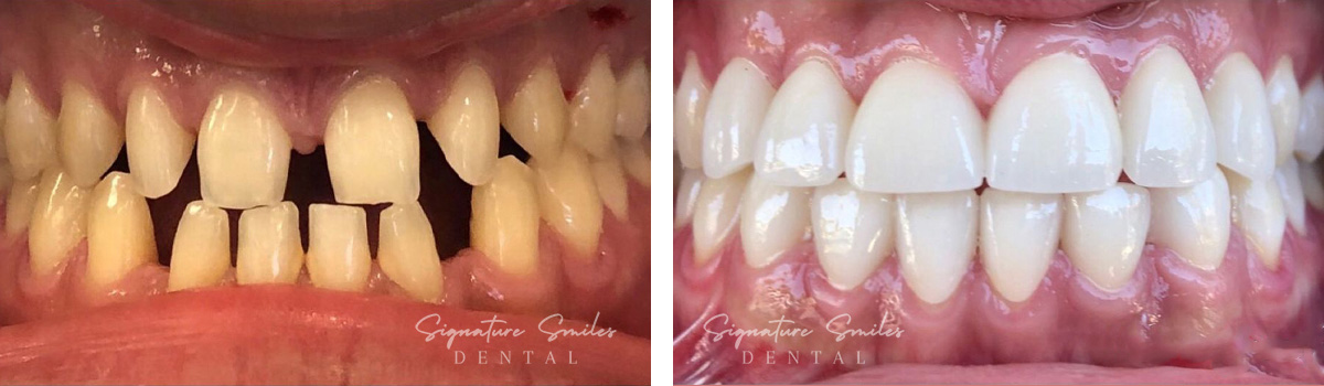 Porcelain Veneers before and after images Signature Smiles Dental 002