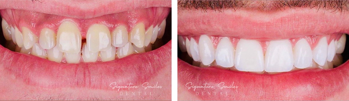 Porcelain Veneers before and after images Signature Smiles Dental 003
