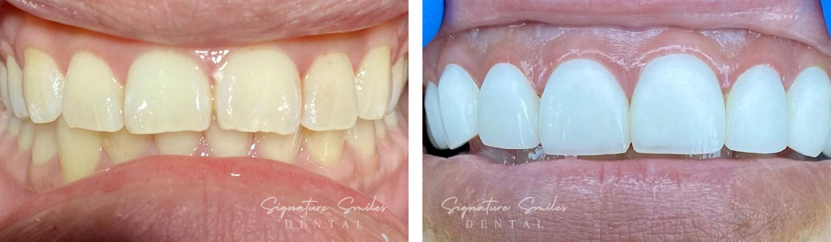 Porcelain Veneers before and after images Signature Smiles Dental 004