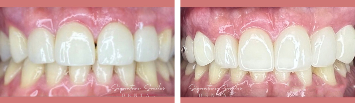 Porcelain Veneers before and after images Signature Smiles Dental 005