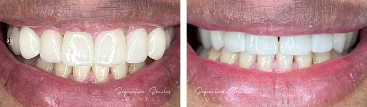 Porcelain Veneers before and after images Signature Smiles Dental 006