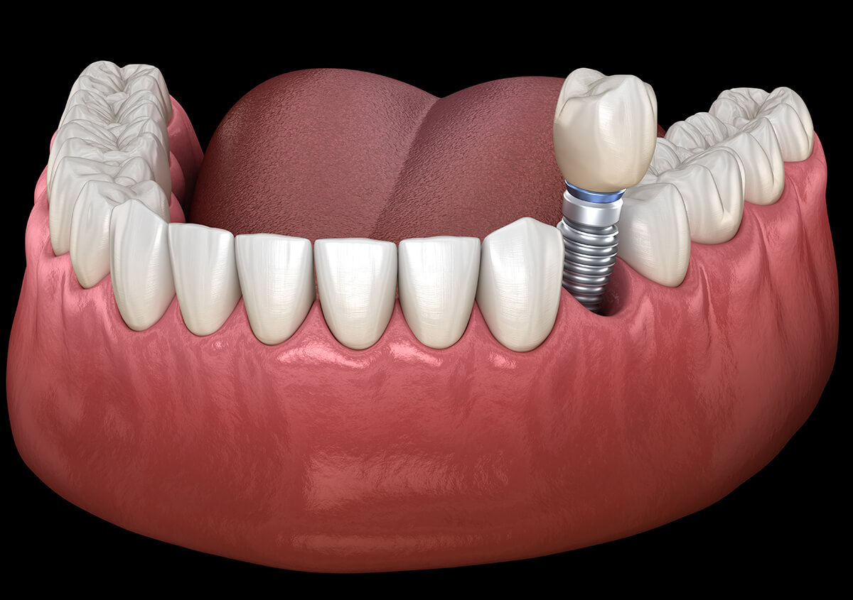 Implants Dentist in Riverside Area